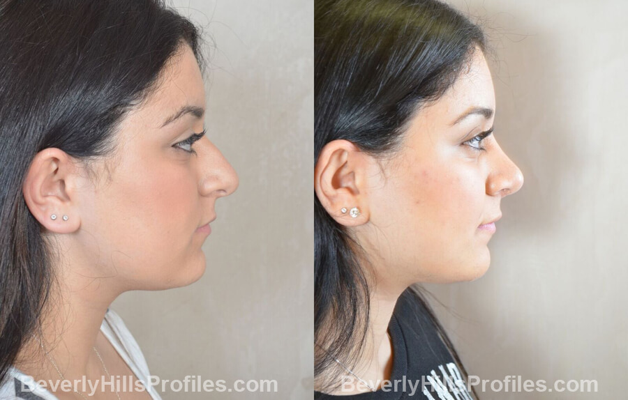 pics Female patient before and after Nose Surgery right side view