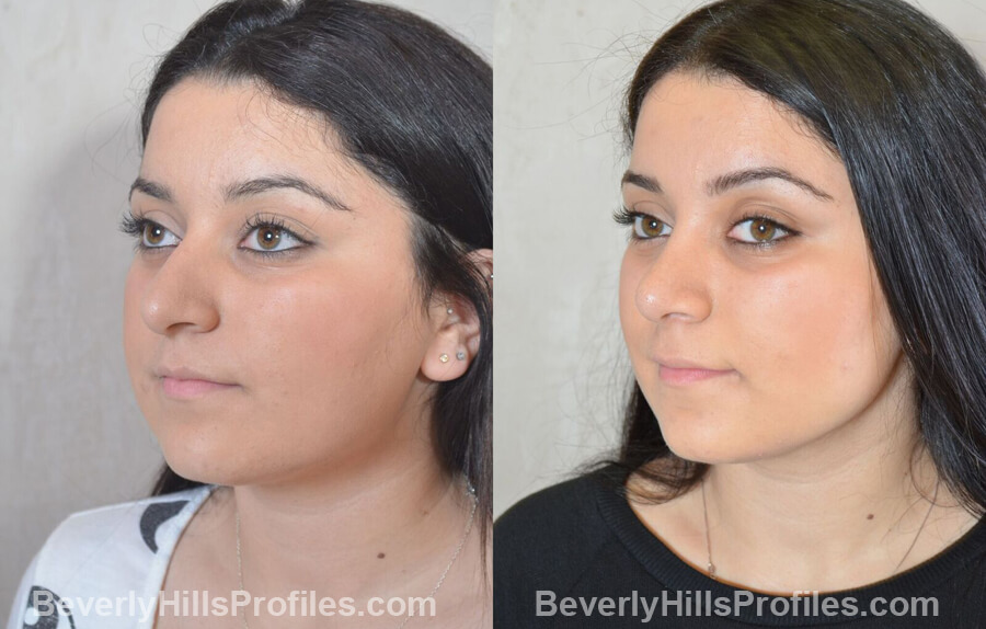 pics Female patient before and after Nose Surgery left oblique view