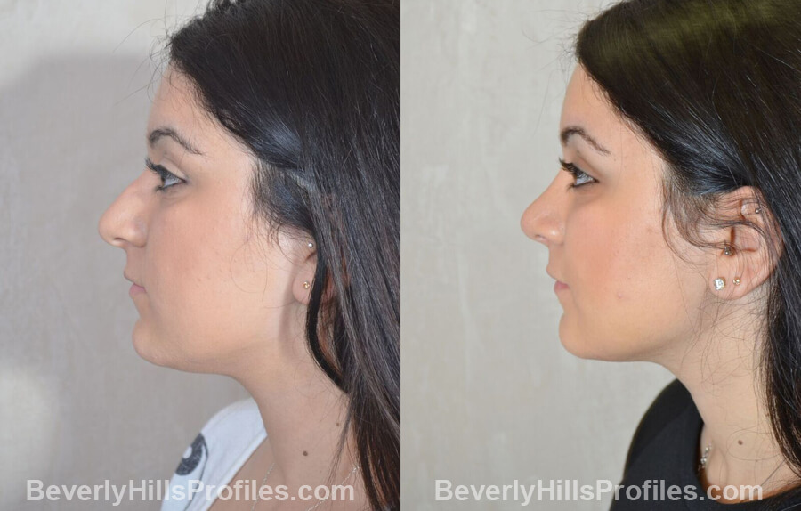 pics Female patient before and after Nose Surgery left side view