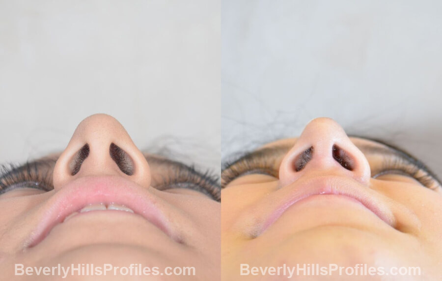 pics Female patient before and after Nose Surgery underside view