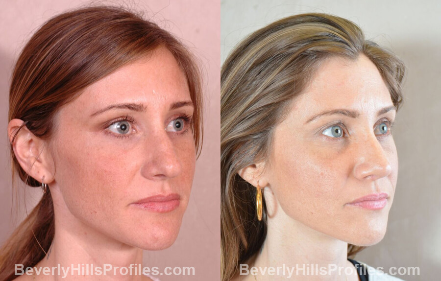 imgs Female patient before and after Nose Surgery - oblique view