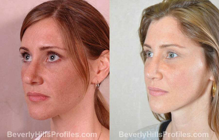 imgs Female patient before and after Nose Surgery - left oblique view