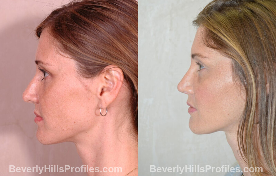 imgs Female patient before and after Nose Surgery - left side view