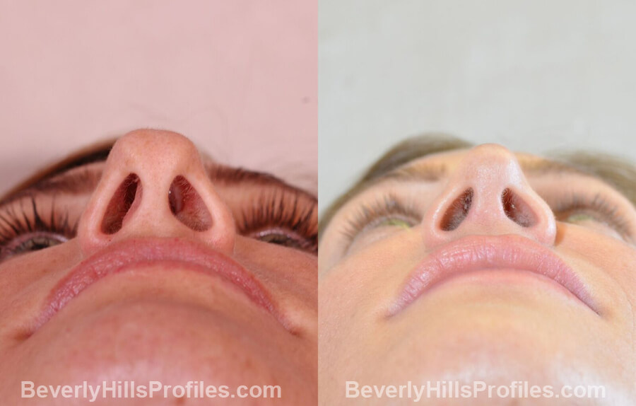 imgs Female patient before and after Nose Surgery - underside view