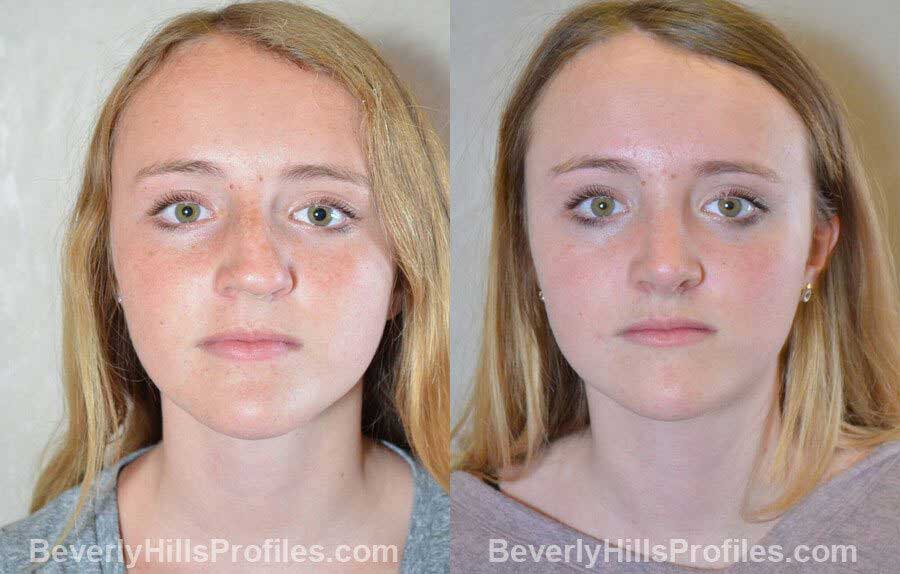 pics Female patient before and after Nose Surgery - front view