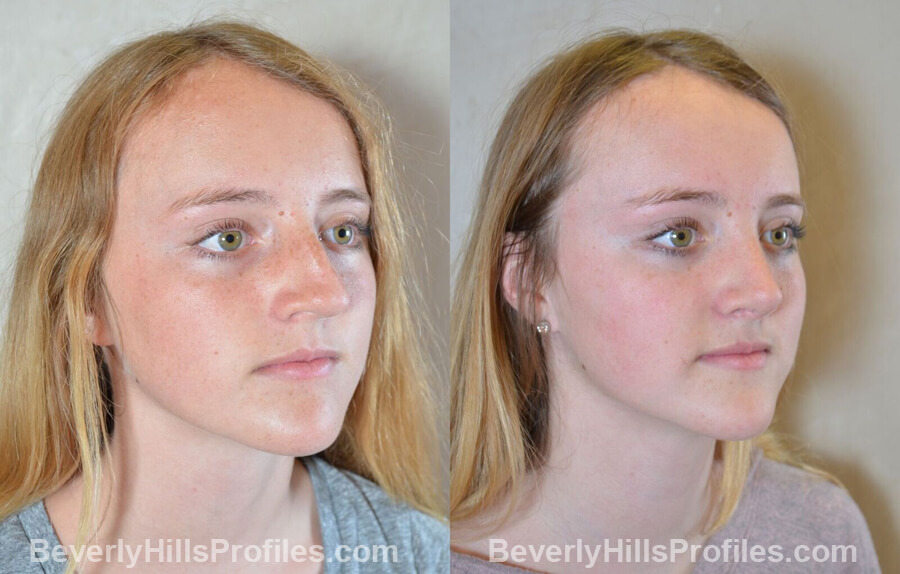 pics Female patient before and after Nose Surgery - oblique view