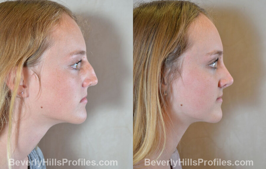 pics Female patient before and after Nose Surgery - right side view