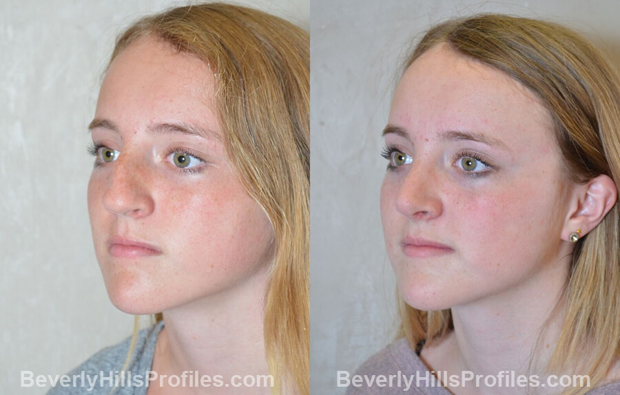 pics Female patient before and after Nose Surgery - left oblique view
