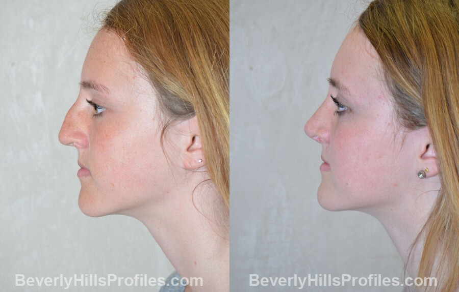 pics Female patient before and after Nose Surgery - left side view