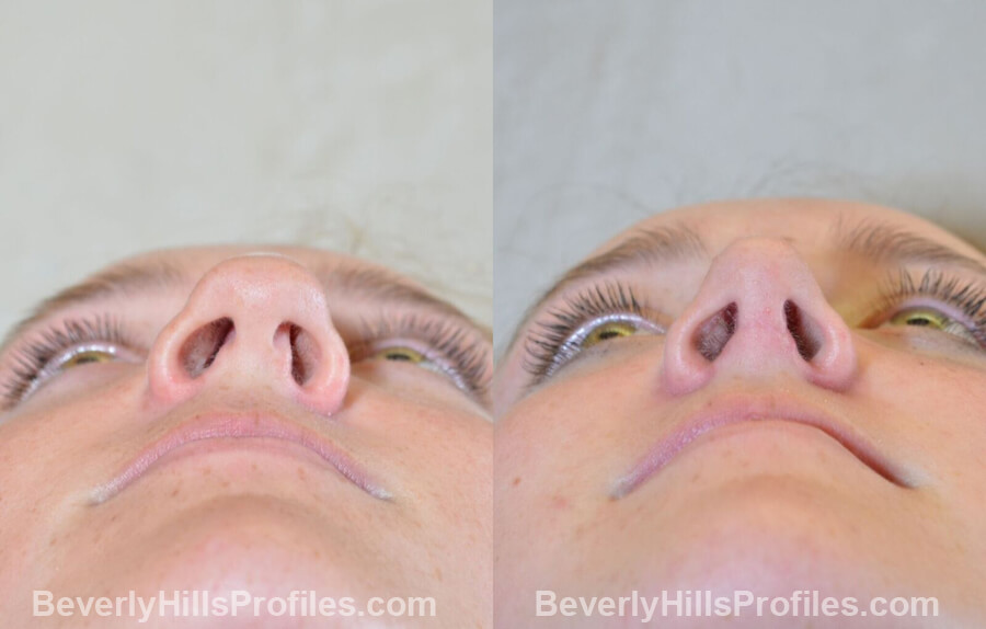 pics Female patient before and after Nose Surgery - underside view
