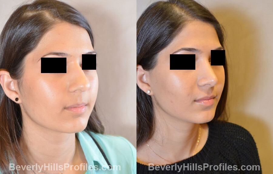 images Female patient before and after Nose Surgery - oblique view