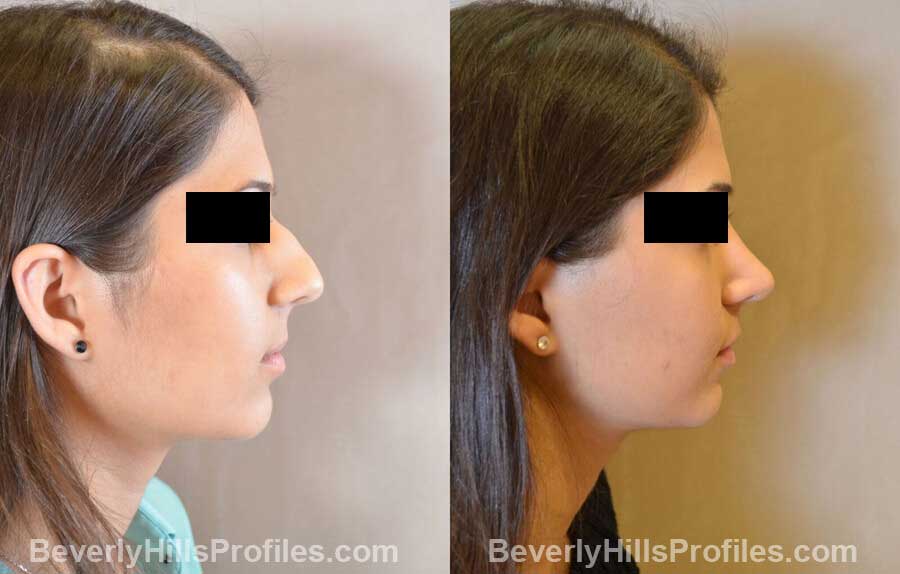 images Female patient before and after Nose Surgery - front view