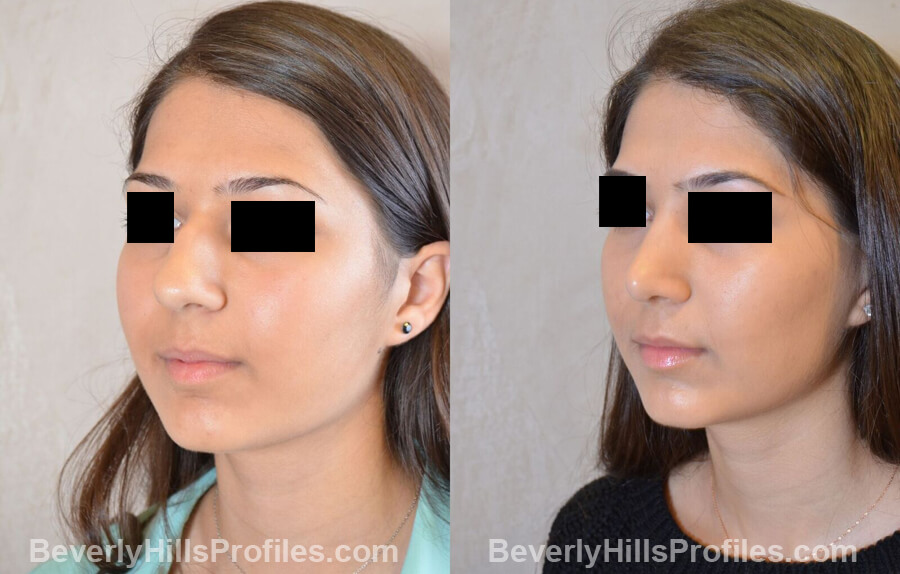 images Female patient before and after Nose Surgery - left oblique view