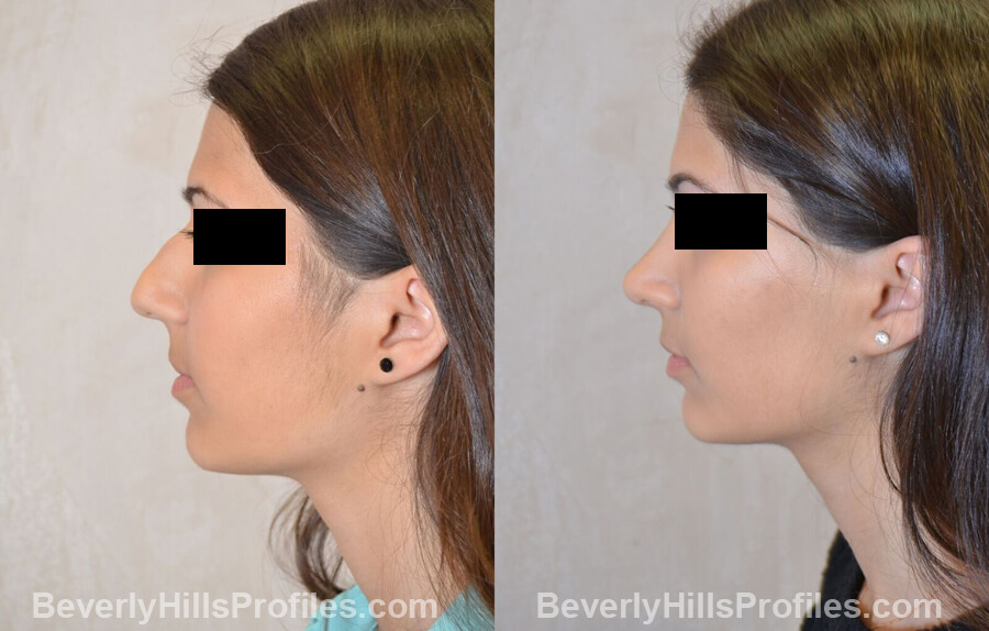 images Female patient before and after Nose Surgery - left side view
