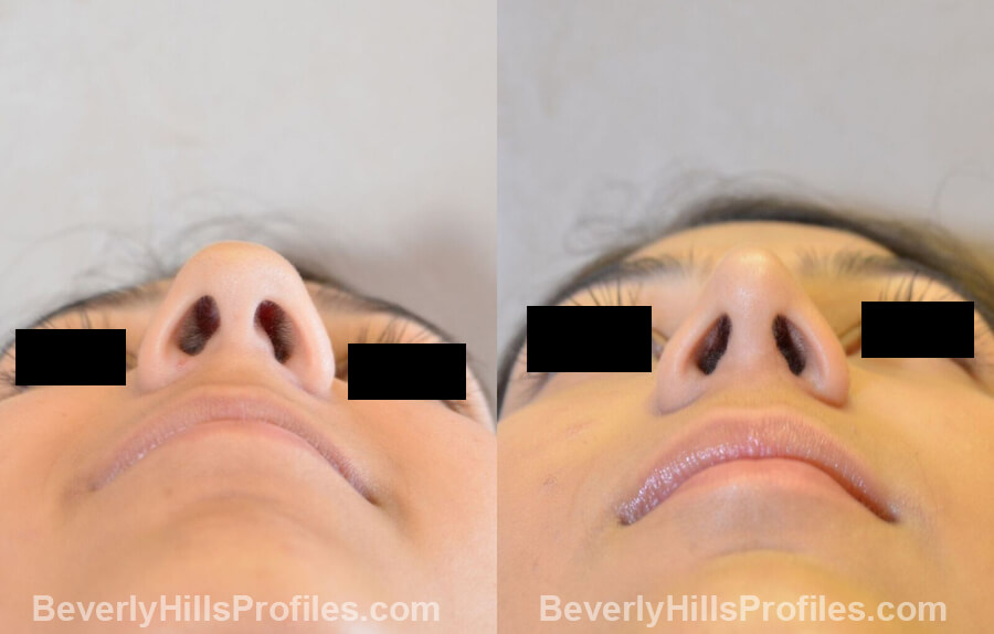images Female patient before and after Nose Surgery - underside view