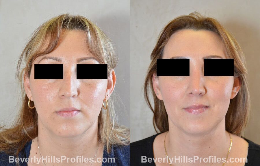 photos Female patient before and after Nose Surgery - front view