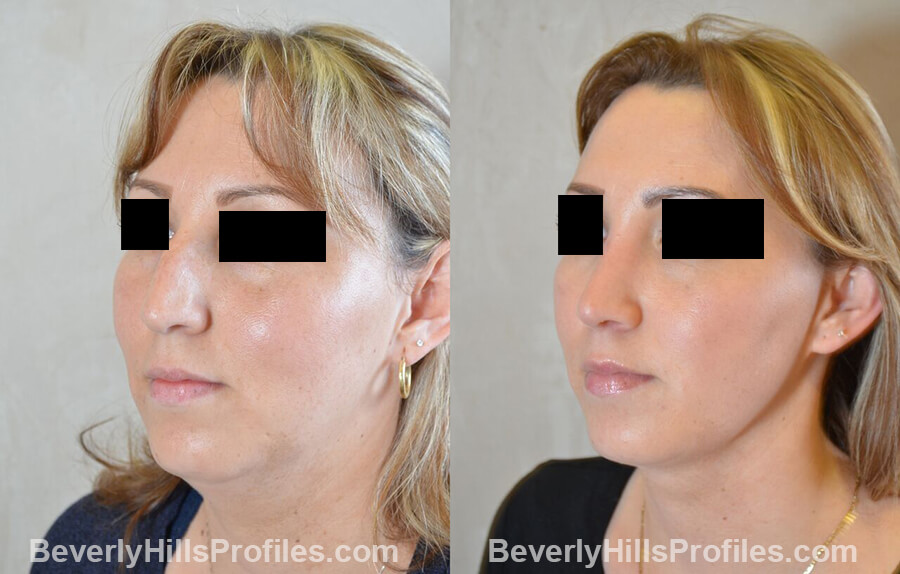 photos Female patient before and after Nose Surgery - left oblique view