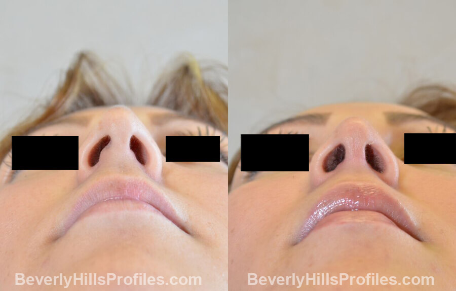 photos Female patient before and after Nose Surgery - underside view