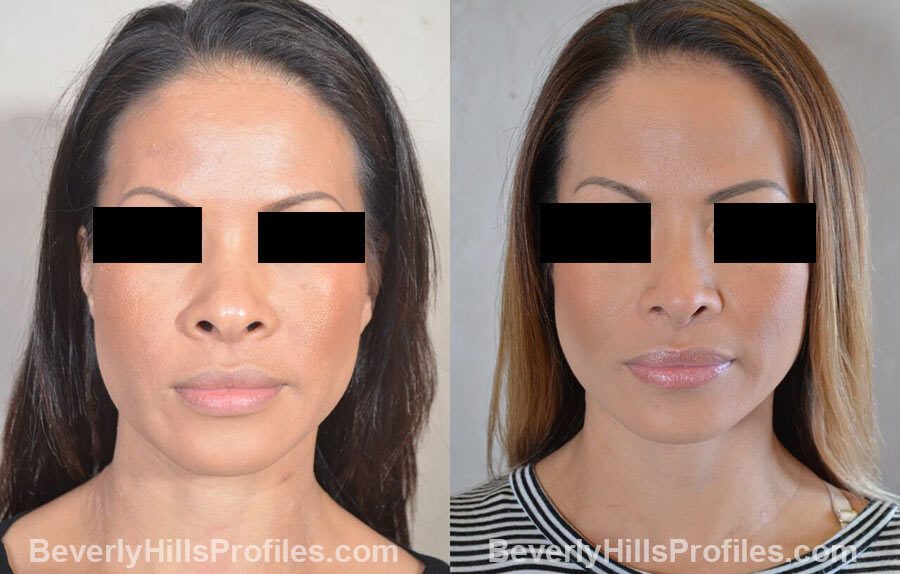 pics Female patient before and after Nose Surgery, front view