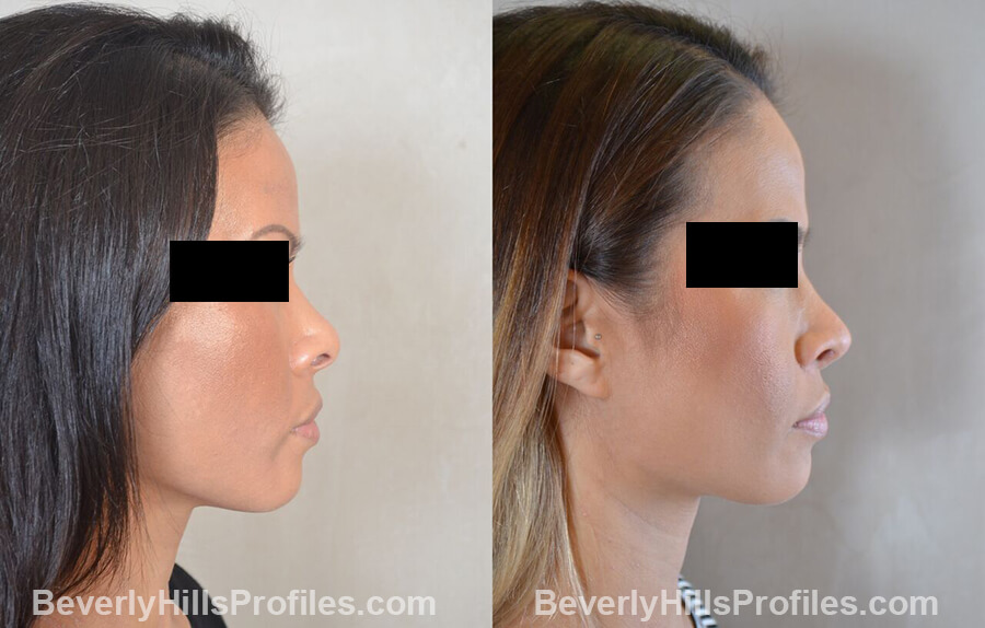 pics Female patient before and after Nose Surgery, right side view