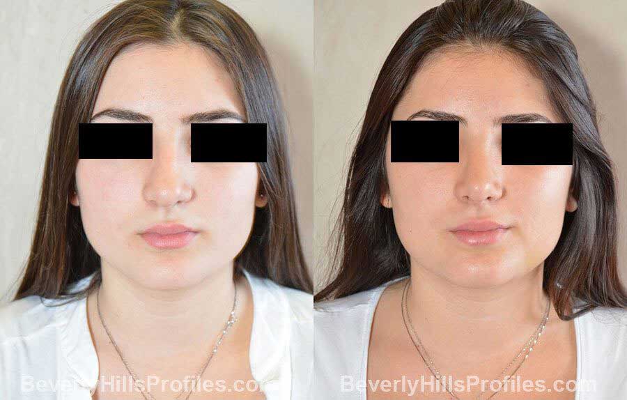 imgs Female patient before and after Nose Surgery front view