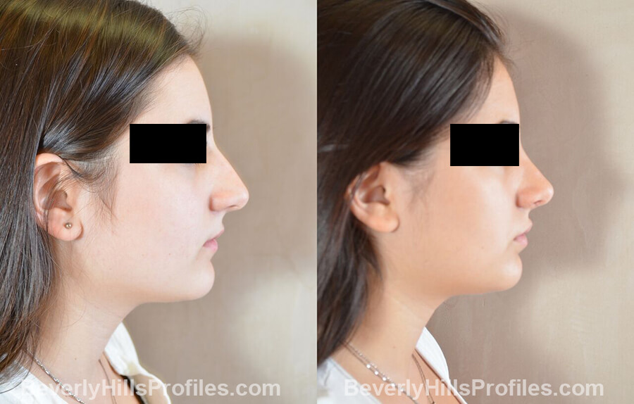 imgs Female patient before and after Nose Surgery right side view
