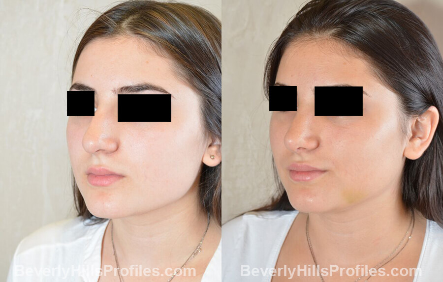 imgs Female patient before and after Nose Surgery left oblique view