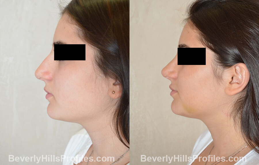 imgs Female patient before and after Nose Surgery left side view