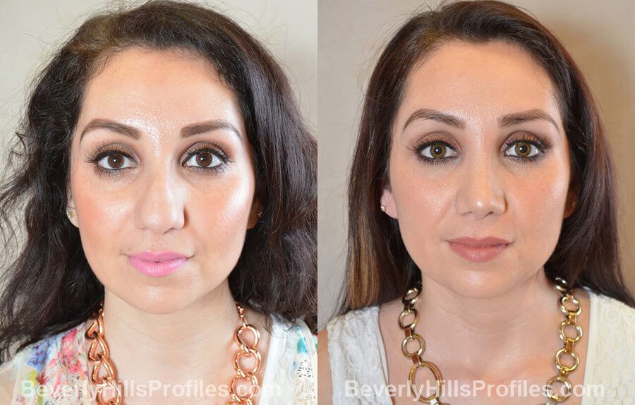 front view Female patient before and after Nose Surgery