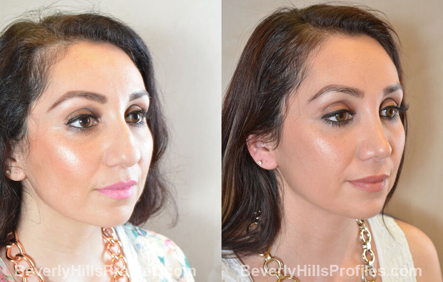 oblique view Female patient before and after Nose Surgery