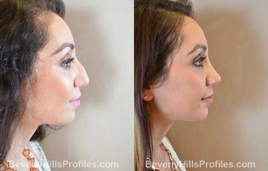 right side view Female patient before and after Nose Surgery