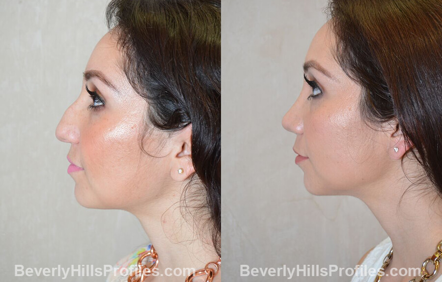 left side view Female patient before and after Nose Surgery