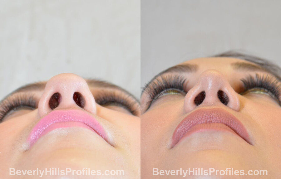 underside view Female patient before and after Nose Surgery