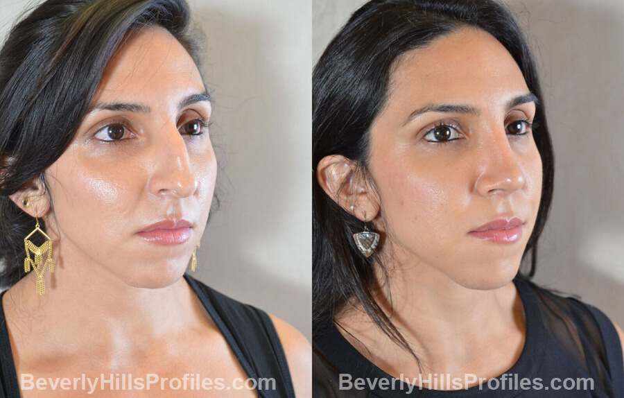 oblique view - Female patient before and after Nose Surgery