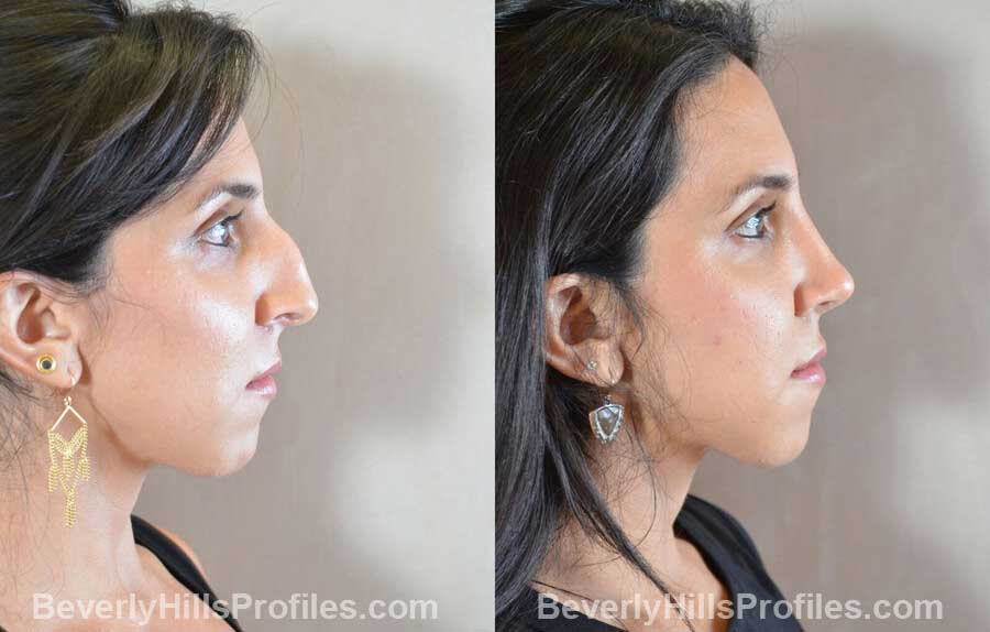 right side view - Female patient before and after Nose Surgery