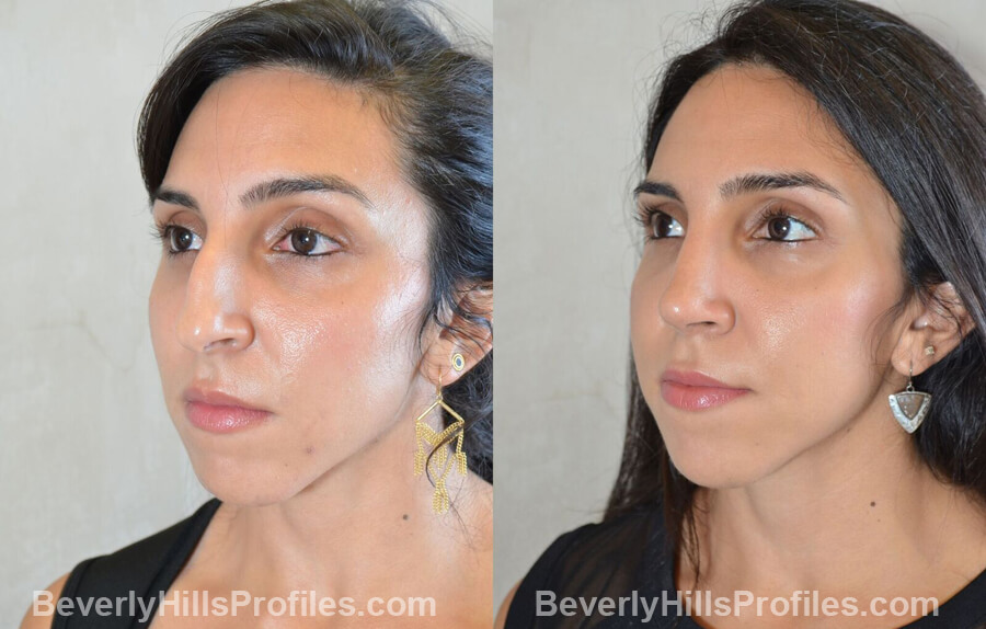 left oblique view - Female patient before and after Nose Surgery