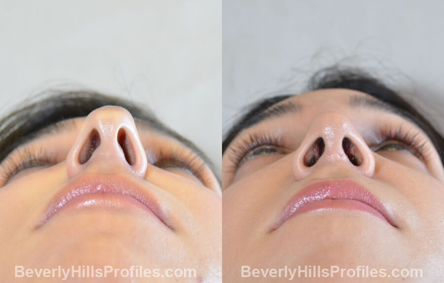 underside view - Female patient before and after Nose Surgery