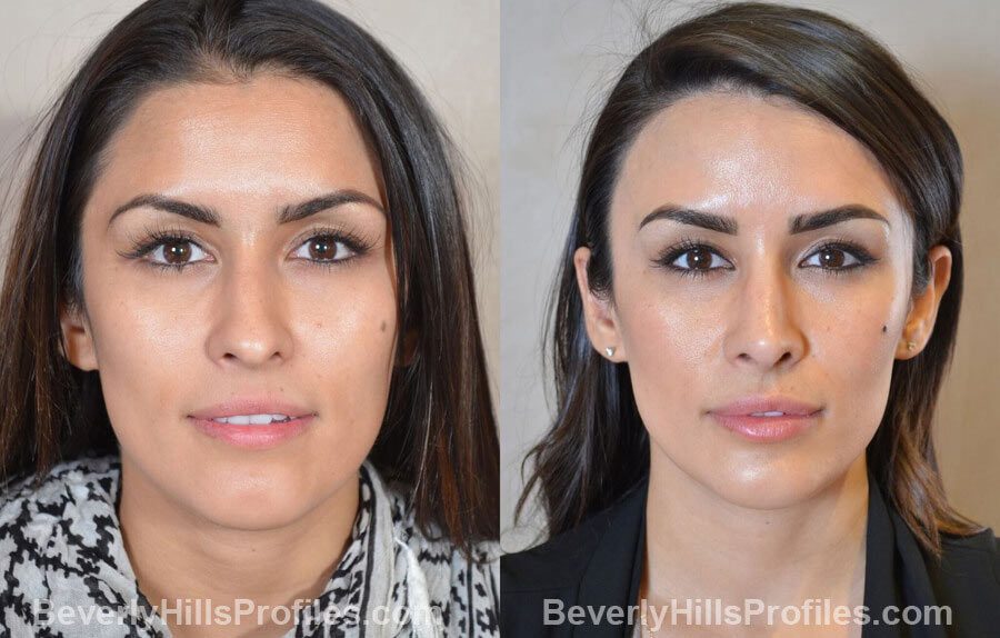 front view - Female patient before and after Nose Surgery Procedures