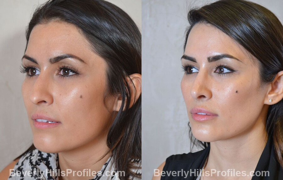 left oblique view - Female patient before and after Nose Surgery Procedures