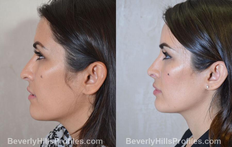 left side view - Female patient before and after Nose Surgery Procedures