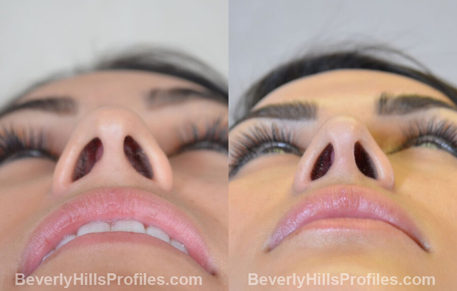 underside view - Female patient before and after Nose Surgery Procedures
