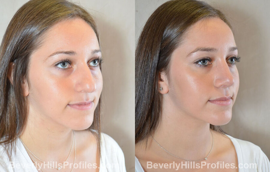oblique view Female patient before and after Nose Surgery Procedures