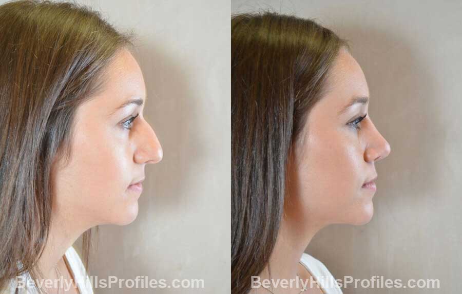 right side view Female patient before and after Nose Surgery Procedures
