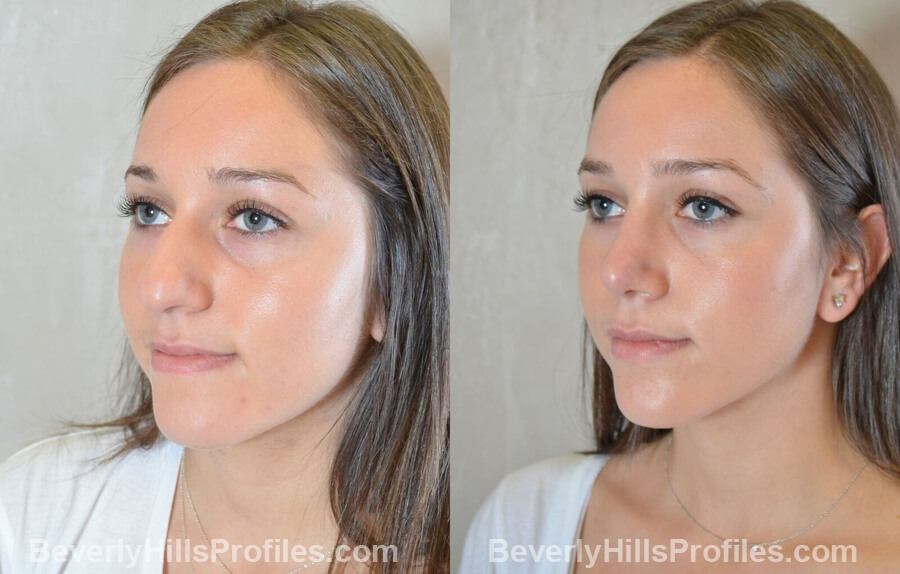 left oblique view Female patient before and after Nose Surgery Procedures
