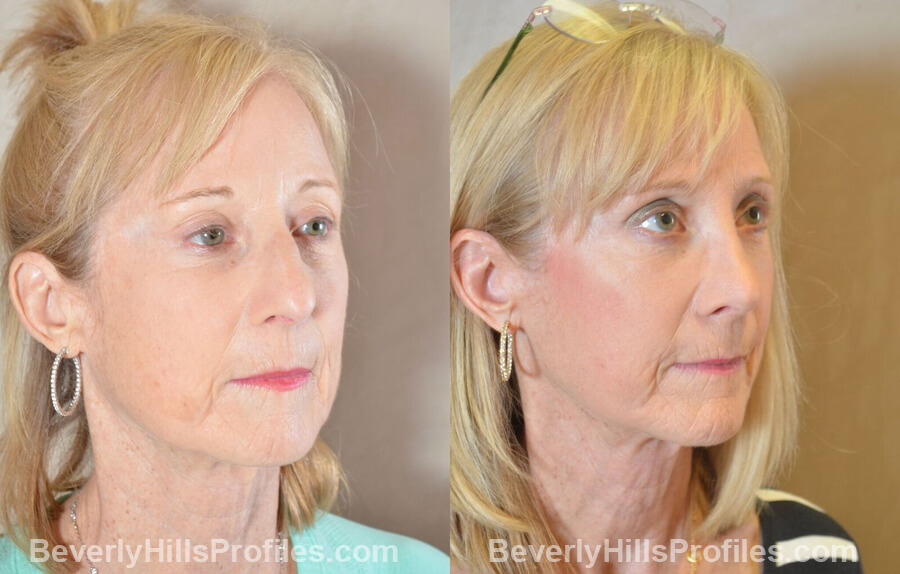 photos Female patient before and after Nose Surgery Procedures - oblique view