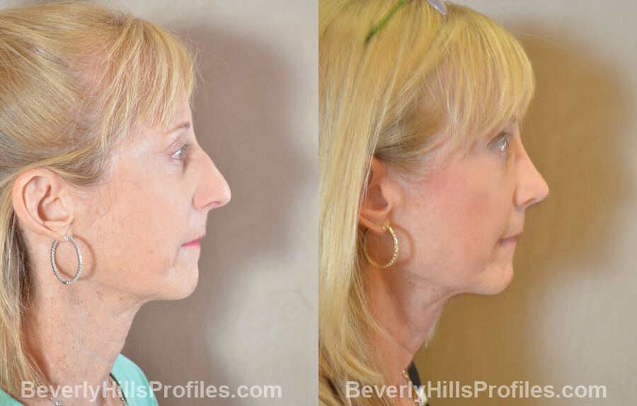 photos Female patient before and after Nose Surgery Procedures - right side view