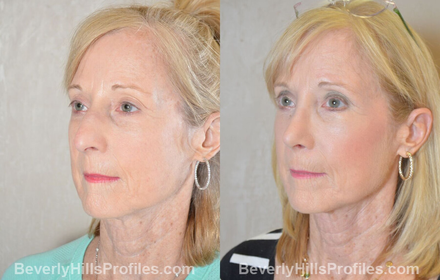 photos Female patient before and after Nose Surgery Procedures - left oblique view