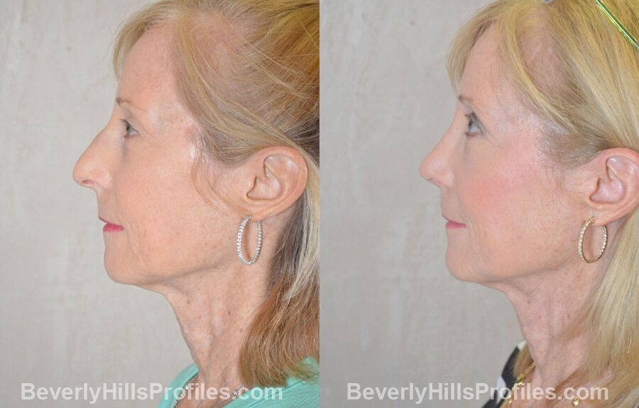 photos Female patient before and after Nose Surgery Procedures - left side view