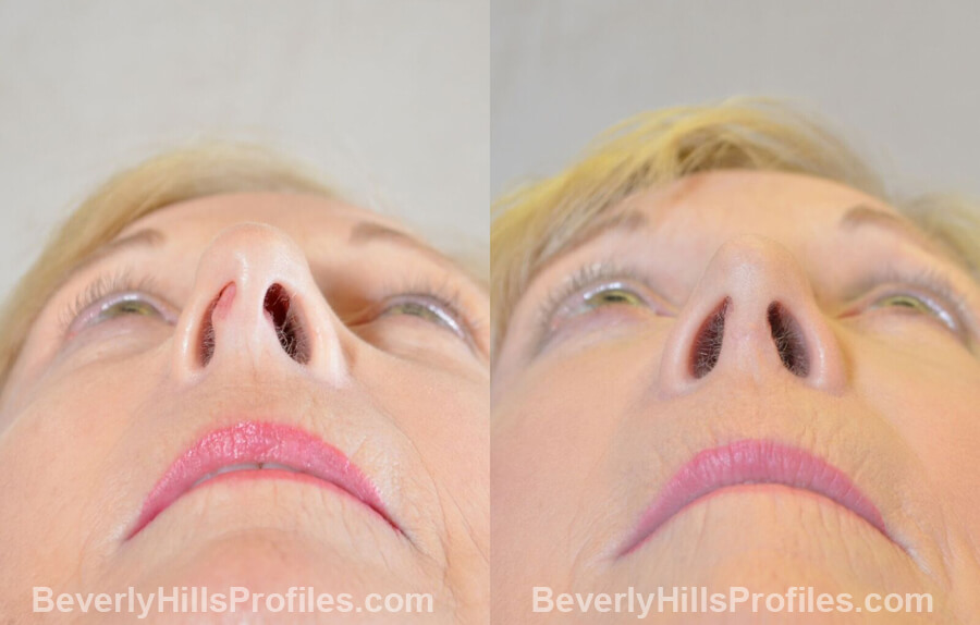 photos Female patient before and after Nose Surgery Procedures - underside view