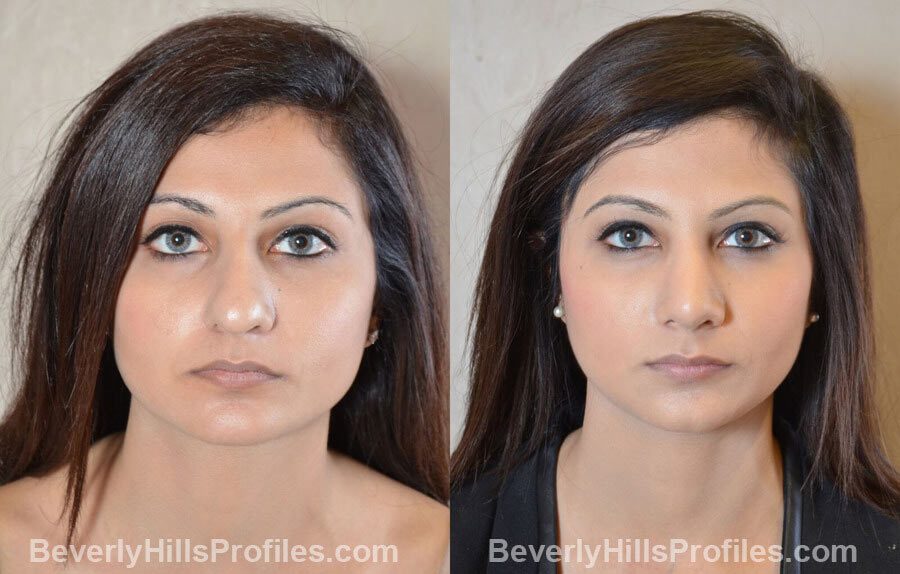 images Female patient before and after Nose Surgery Procedures - front view